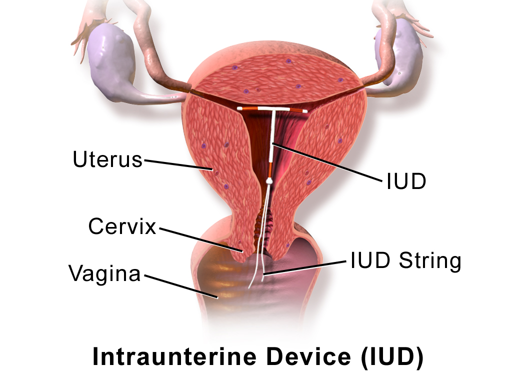 Why Intrauterine Device (IUD) is one of the trendiest contraceptives